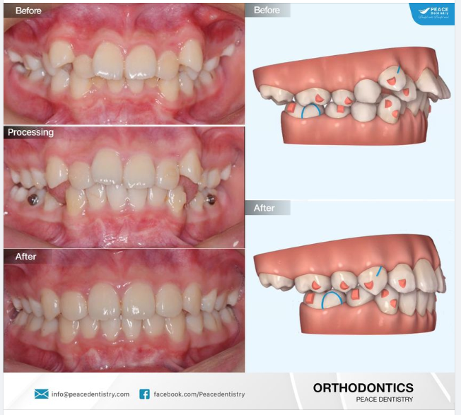 INVISALIGN VÀ NHỮNG CA CHỈNH NHA KHÓ, PHỨC TẠP: