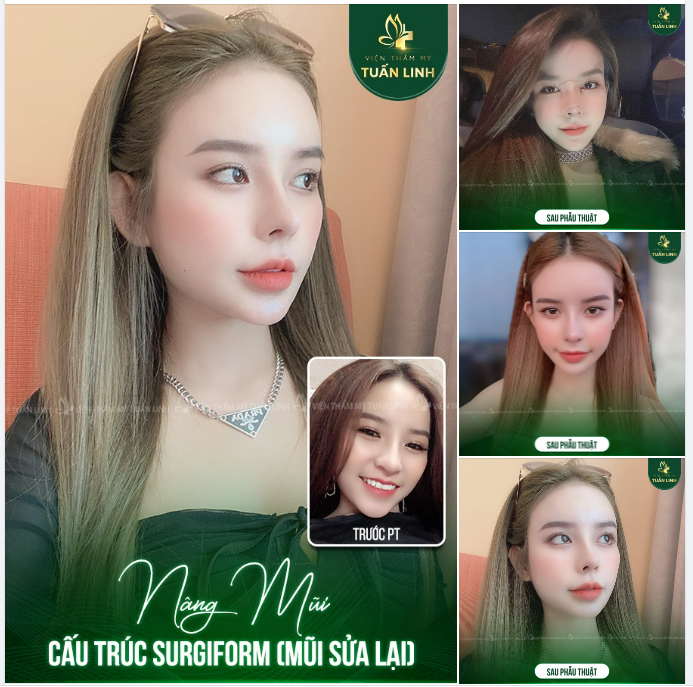 Khoe ngay chiếc mũi đẹp xịn xò sau khi nâng cấu trúc sử dụng sụn Surgiform tại Tuấn Linh!!