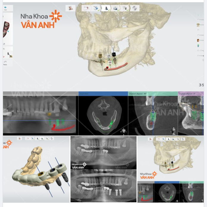 TRỒNG RĂNG HISAFE IMPLANT - CẤY GHÉP CHÍNH XÁC 99,99% - AN TOÀN KHÔNG ĐAU