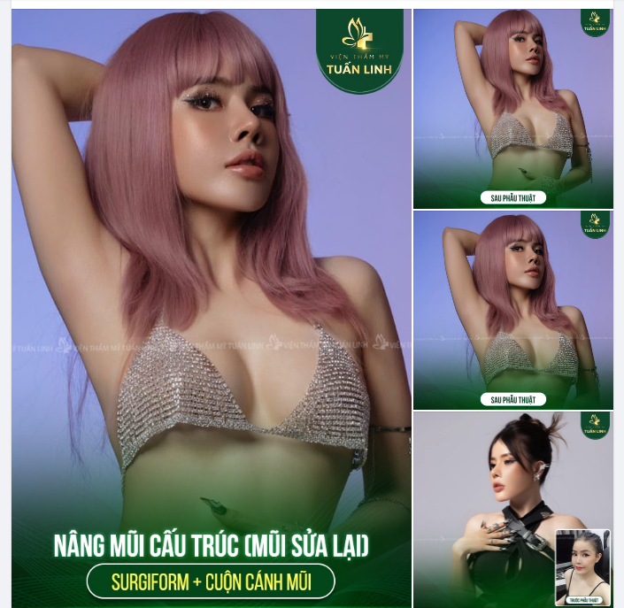 TÁI TẠO MŨI XẤU - LÊN DÁNG MŨI MỚI ĐẸP MÊ LY