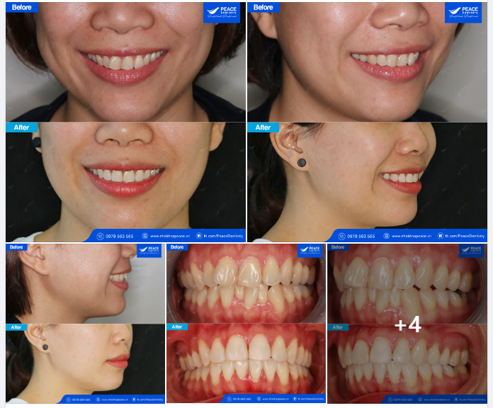Hành trình niềng răng của mình bắt đầu cách đây hơn 1 năm rưỡi, có thể đến hơi muộn nhưng mình vẫn cảm thấy may mắn và biết ơn nhiều lắm.