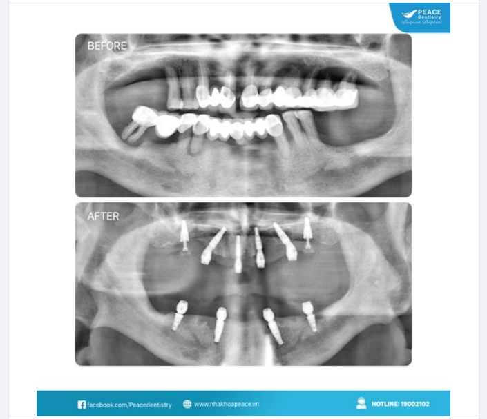 Thay thế cầu răng sứ dài "liên lục địa" bằng All-on-4 Implant ​​​​​​​ Một lựa chọn lý tưởng để khôi phục trọn vẹn chức năng ăn nhai, chức năng thẩm mỹ và giúp khuôn mặt trẻ trung hơn.
