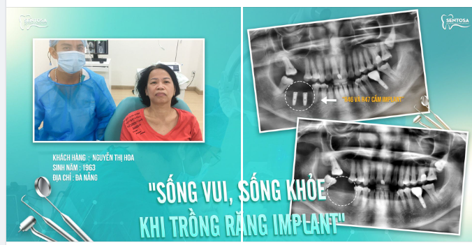 "SỐNG VUI, SỐNG KHỎE KHI TRỒNG RĂNG IMPLANT"