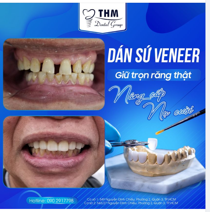DÁN SỨ VENEER - GIỮ TRỌN RĂNG THẬT, NÂNG CẤP NỤ CƯỜI