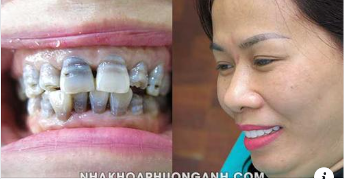 Những yếu tố ảnh hưởng đến độ bền và thẩm mỹ của răng sứ