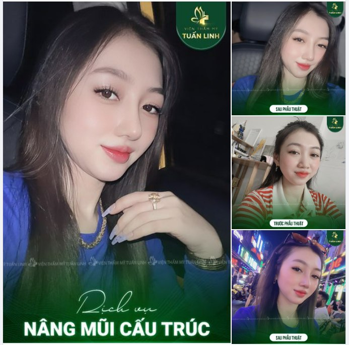 XINH ĐẸP THANH TÚ HƠN VỚI NÂNG MŨI CẤU TRÚC