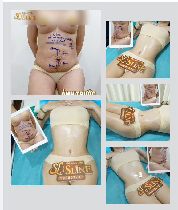 PHẢN HỒI THỰC TẾ Sau 14 ngày thực hiện quá trình : hút mỡ tạo hình toàn thể và tạo rốn mới .