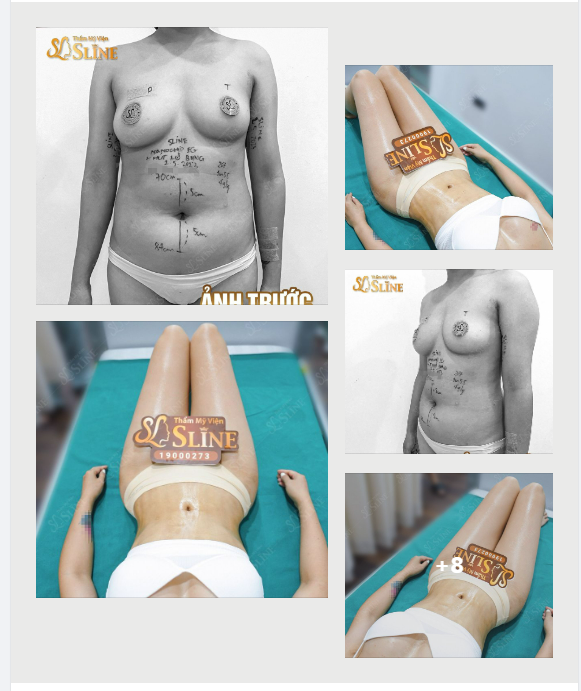 COMBO: Hút mỡ bụng Nâng cấp vòng 1