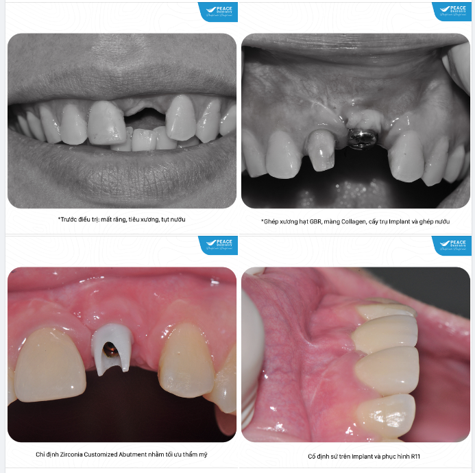 Đây là một ca lâm sàng trồng răng implant có ghép xương và ghép nướu. Kết quả sau điều trị: bạn không thể phân biệt được đâu là răng thật và đâu là "răng Implant".