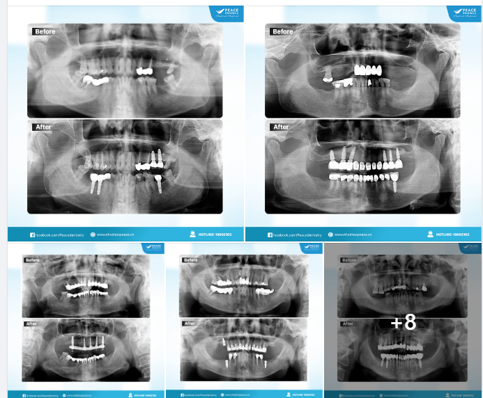 (Một số hình ảnh Trước và Sau một số ca cấy ghép Implant được thực hiện bởi các bác sĩ chuyên gia của Hệ Thống Peace Dentistry).