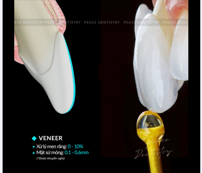 XỬ LÝ MEN RĂNG TRONG CHỈ ĐỊNH MẶT DÁN SỨ VENEER: