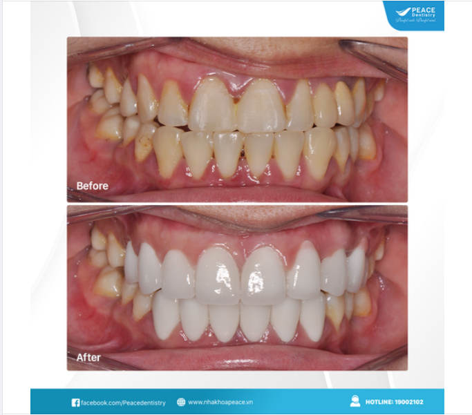 Thẩm mỹ cao, hạn chế mài răng (bảo tồn tối đa răng tự nhiên) và mỏng... Vậy veneer có độ bền như thế nào? Có dễ gãy, mẻ, bung sút hay không? - Đó là vấn đề rất nhiều khách hàng quan tâm khi làm mặt dán sứ Veneer.