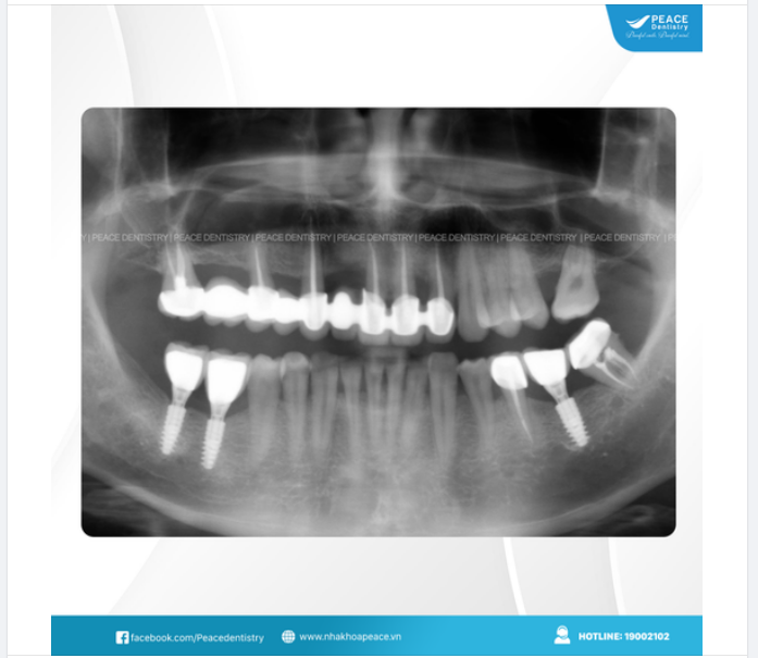 TRỒNG RĂNG IMPLANT - THÁCH THỨC VƯỢT THỜI GIAN