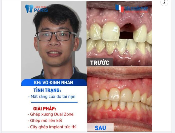 MẤT RĂNG DO TAI NẠN PHẢI LÀM SAO?