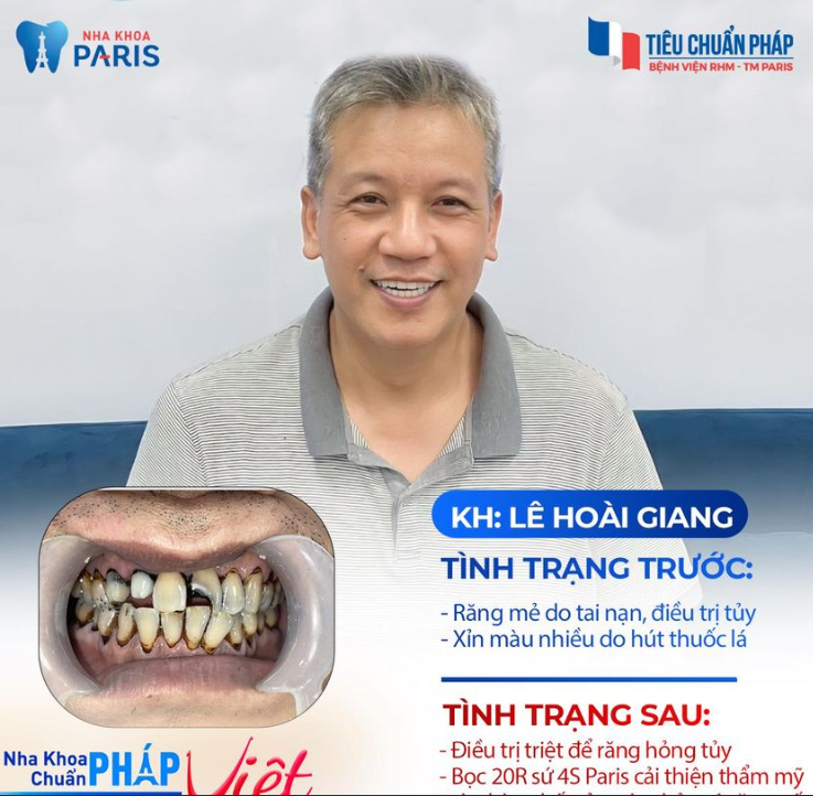 Tút lại sự phong độ cho chú Hoài Giang tới từ Hà Nội sau bọc răng sứ tại Nha khoa Paris!