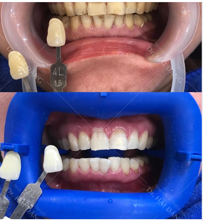 TẨY TRẮNG RĂNG KHẮC PHỤC Ố VÀNG