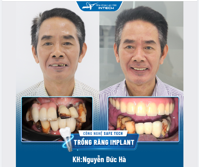 TRỒNG RĂNG XONG ĂN ĐƯỢC CẢ KẸO LẠC, CẢ NGÔ