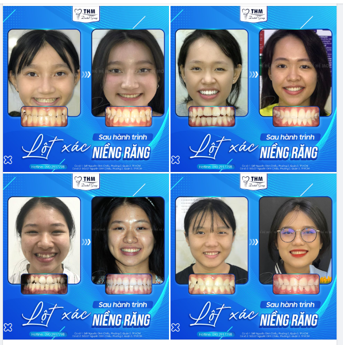 NIỀNG RĂNG ĐÃ LÀM KHÁCH HÀNG THAY ĐỔI NHƯ THẾ NÀO?