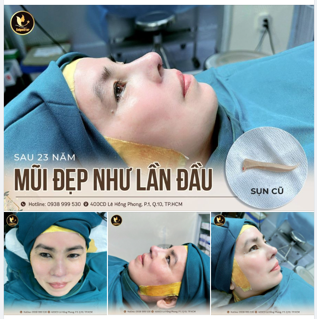 SAU 23 NĂM – MŨI ĐẸP NHƯ LẦN ĐẦU