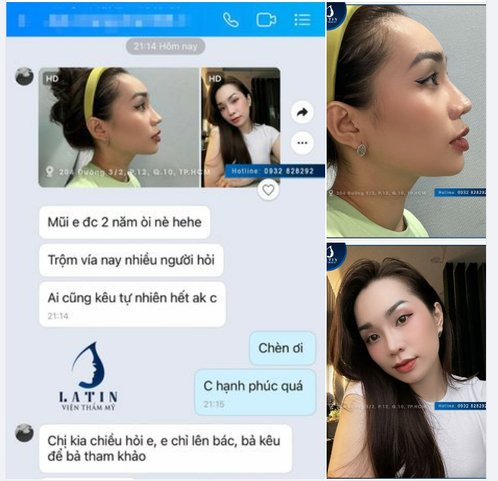 MŨI TÁI CẤU TRÚC SAU 2 NĂM SIÊU TỰ NHIÊN