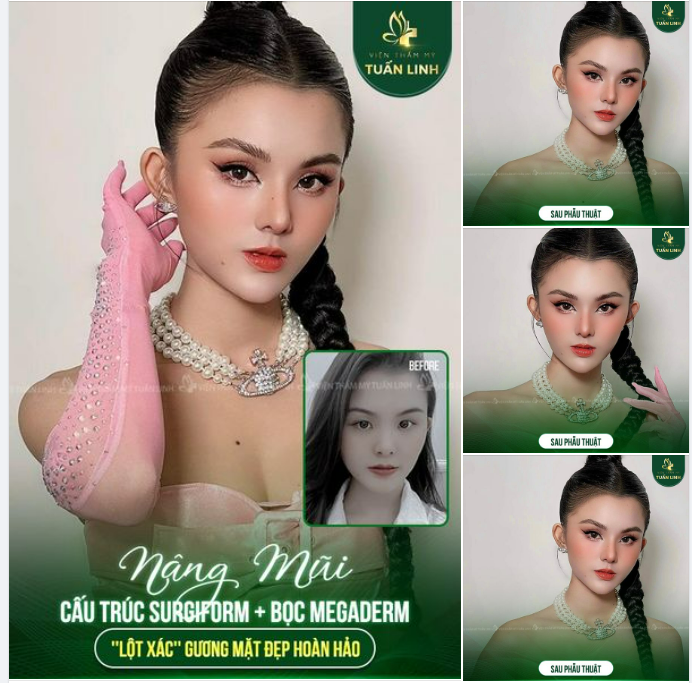 Nâng mũi cấu trúc Surgiform bọc Megaderm Đẹp sang chảnh - Chuẩn phong thủy!!
