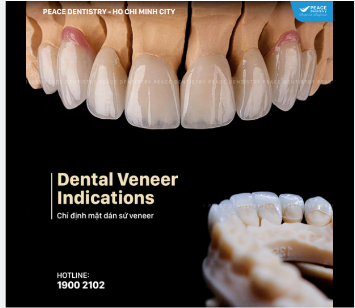 5 VẤN ĐỀ PHỔ BIẾN PHÙ HỢP ĐỂ CHỈ ĐỊNH MẶT DÁN SỨ VENEER