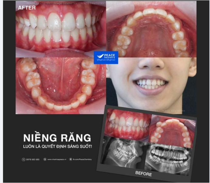 NIỀNG RĂNG MẮC CÀI SỨ - THẨM MỸ HƠN VÀ TIẾT KIỆM HƠN