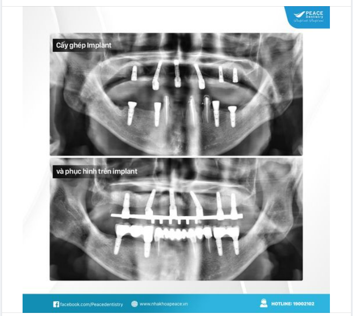 Ca lâm sàng Implant với kế hoạch: All on 6 Implant cho hàm trên và 4 đơn vị implant thường quy cho hàm dưới... giúp khôi phục trọn vẹn chức năng ăn nhai và thẩm mỹ nụ cười cho chú khách hàng Việt Kiều. (Hiossen Implant, made in USA)