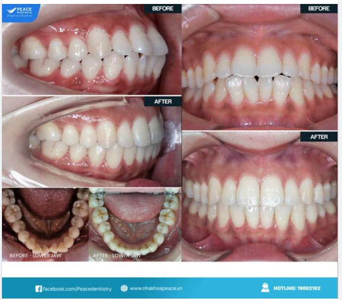 Tận hưởng mùa hè thật sảng khoái cùng hành trình niềng răng Invisalign tại Peace Dentistry