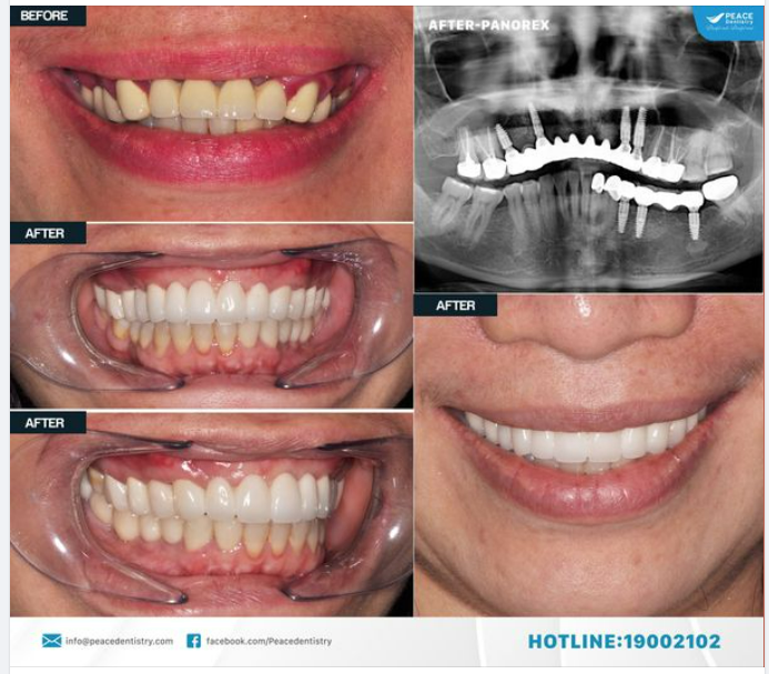 Ca lâm sàng: thay thế cầu răng sứ dài đã xuống cấp bằng implant giúp mang lại giá tri vượt trội cho khách hàng