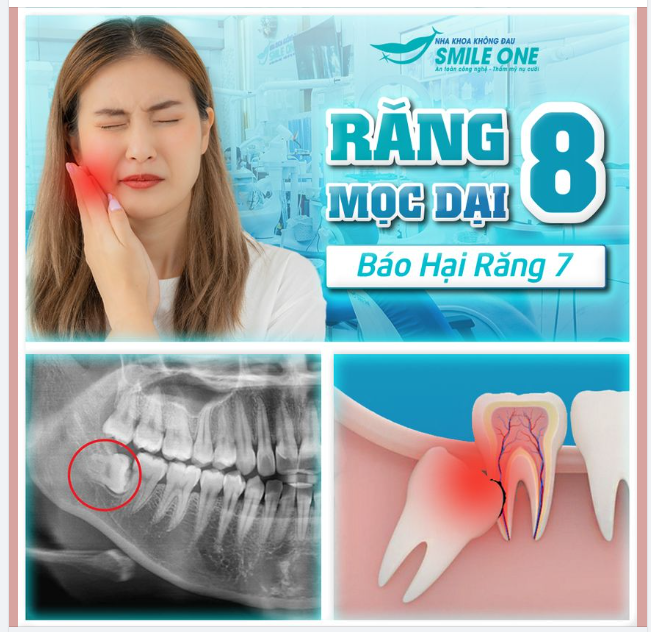 Răng khôn lệch làm hỏng răng 7.