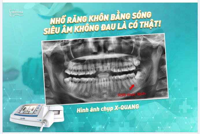 NHỔ RĂNG KHÔN BẰNG SÓNG SIÊU ÂM KHÔNG ĐAU LÀ CÓ THẬT!