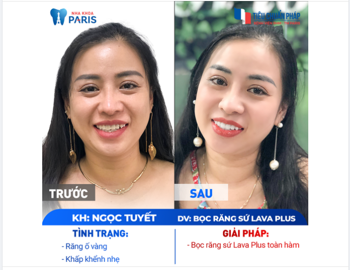 Chị Tuyết đã trẻ ra hẳn 10 tuổi sau bọc răng sứ. Còn các chị em khác thì sao?