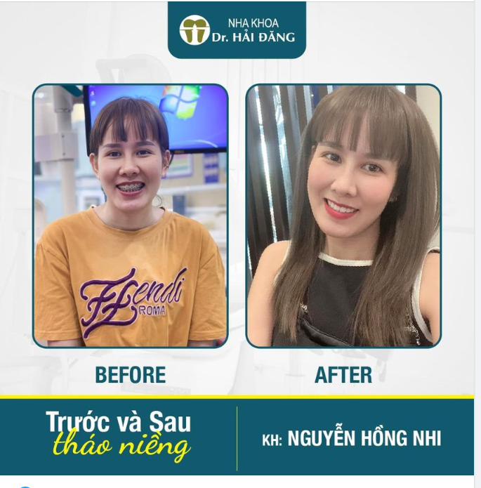 “Mùa Hạ năm ngoái ta làm quen với những chiếc mắc cài đủ màu sắc, mùa hạ năm nay ta lại có nụ cười toả nắng lung linh"