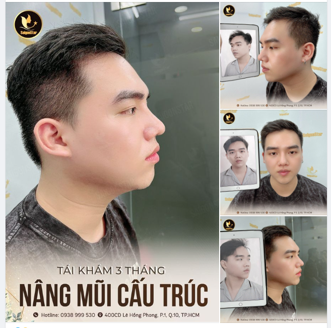 3 THÁNG MŨI ĐẸP CHUẨN SOÁI CA