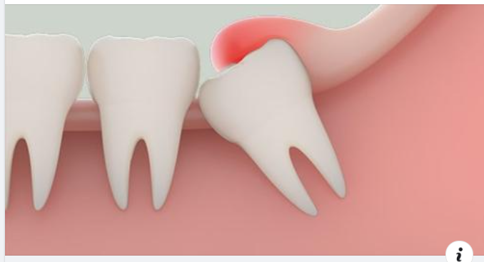 Nguyên nhân và hậu quả khi sâu răng số 8? Sâu răng số 8 nên làm gì?