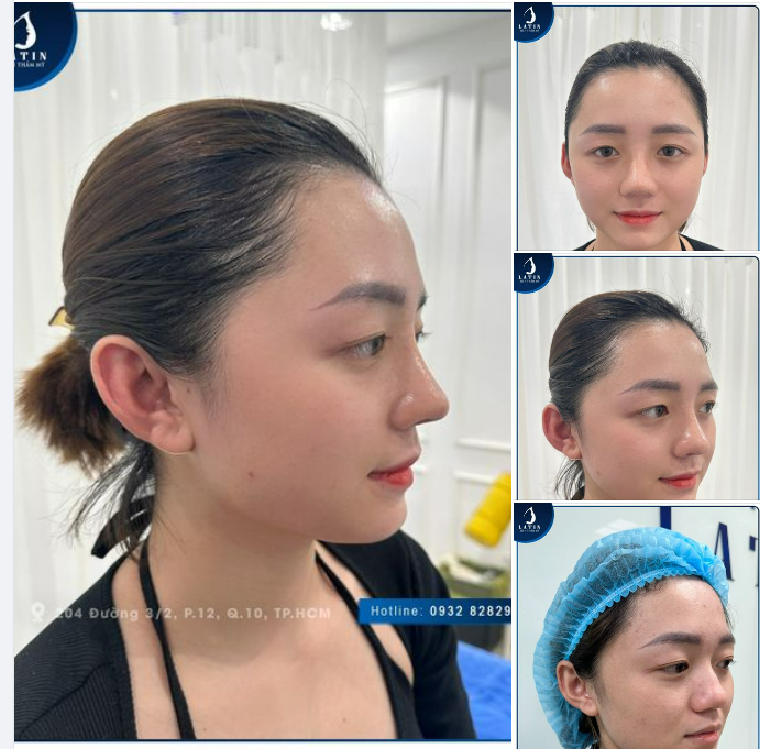 Mũi cấu trúc 10 ngày siêu đẹp cho em gái Cần Thơ