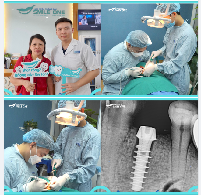 Trồng implant R34 khách hàng Nguyễn Thị Hồng Nhung 46 tuổi!