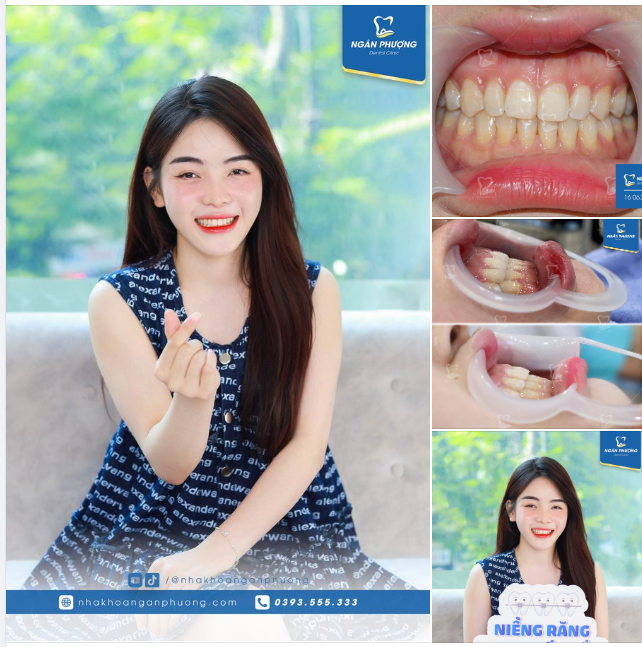 Mắt cười tô điểm khuôn trang. Răng đều cười đẹp cùng nàng tự tin