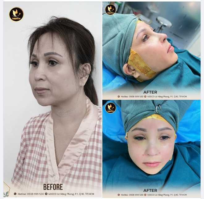 NGƯỜI THẬT – HÌNH THẬT – HIỆU QUẢ THẬT KẾT QUẢ SAU HƠN 60 PHÚT CHO KHÁCH HÀNG VIỆT KIỀU: