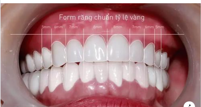 5 tiêu chuẩn hàm răng đẹp tự nhiên mà bạn nên biết