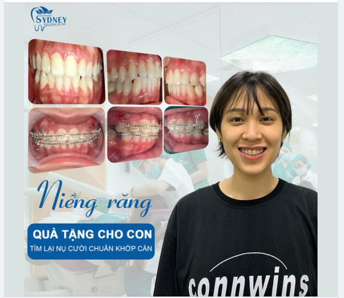 CHI PHÍ NIỀNG RĂNG KHÔNG CÒN LÀ NỖI LO NGẠI!