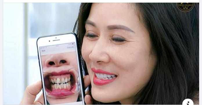 Cách Chọn Màu Răng Sứ Tự Nhiên Nhất?