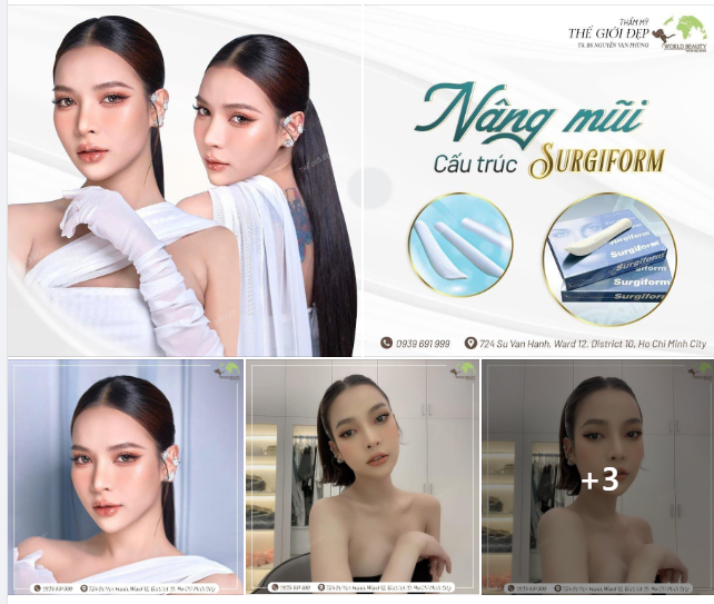 Để có được vẻ ngoài nữ tính hơn, quý Cô quyết định tìm đến Thế Giới Đẹp thay đổi dáng mũi cũ hơi to thô của mình bằng giải pháp Nâng mũi cấu trúc.