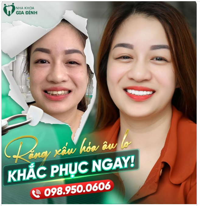 RĂNG XẤU HÓA ÂU LO - KHẮC PHỤC NGAY CÙNG THẨM MỸ RĂNG SỨ