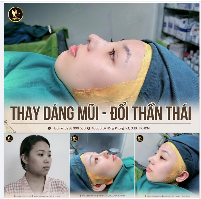 THAY DÁNG MŨI - ĐỔI THẦN THÁI