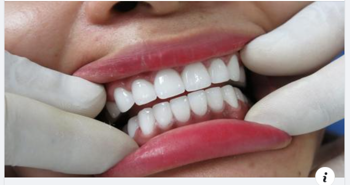 Cảm giác sau khi bọc răng sứ: Những điều bất thường cần lưu ý