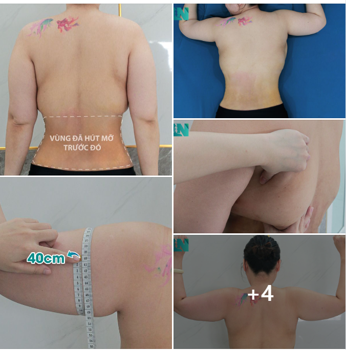 VÙNG TAY, LƯNG, NÁCH CHO CHỊ KH 7X: ĐÃ THỰC HIỆN HÚT MỠ BỤNG HƠN 1 TUẦN TRƯỚC. 