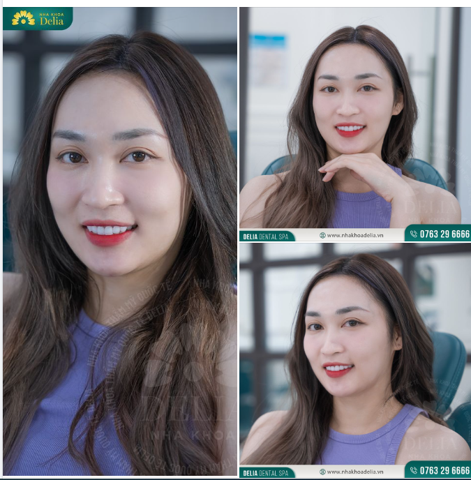 Xử lý răng khấp khểnh, xỉn màu - Kiều bào Đài Loan tự tin khoe nụ cười rạng rỡ