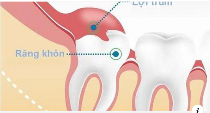 Lợi trùm răng khôn: Dấu hiệu nhận biết và cách xử trí